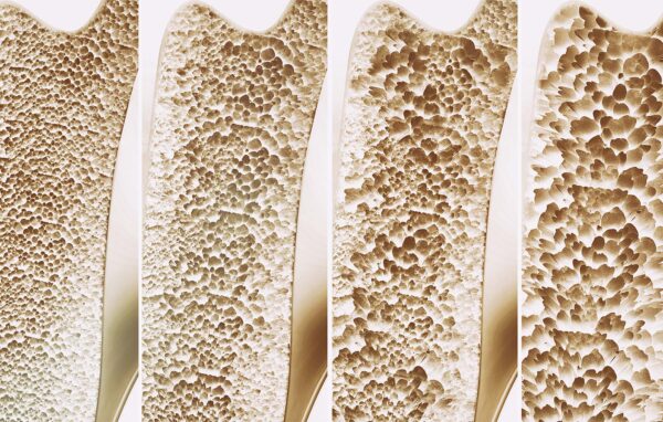 Bei Osteoporose baut sich die Knochensubstanz ab und die Knochen werden porös und brüchig.